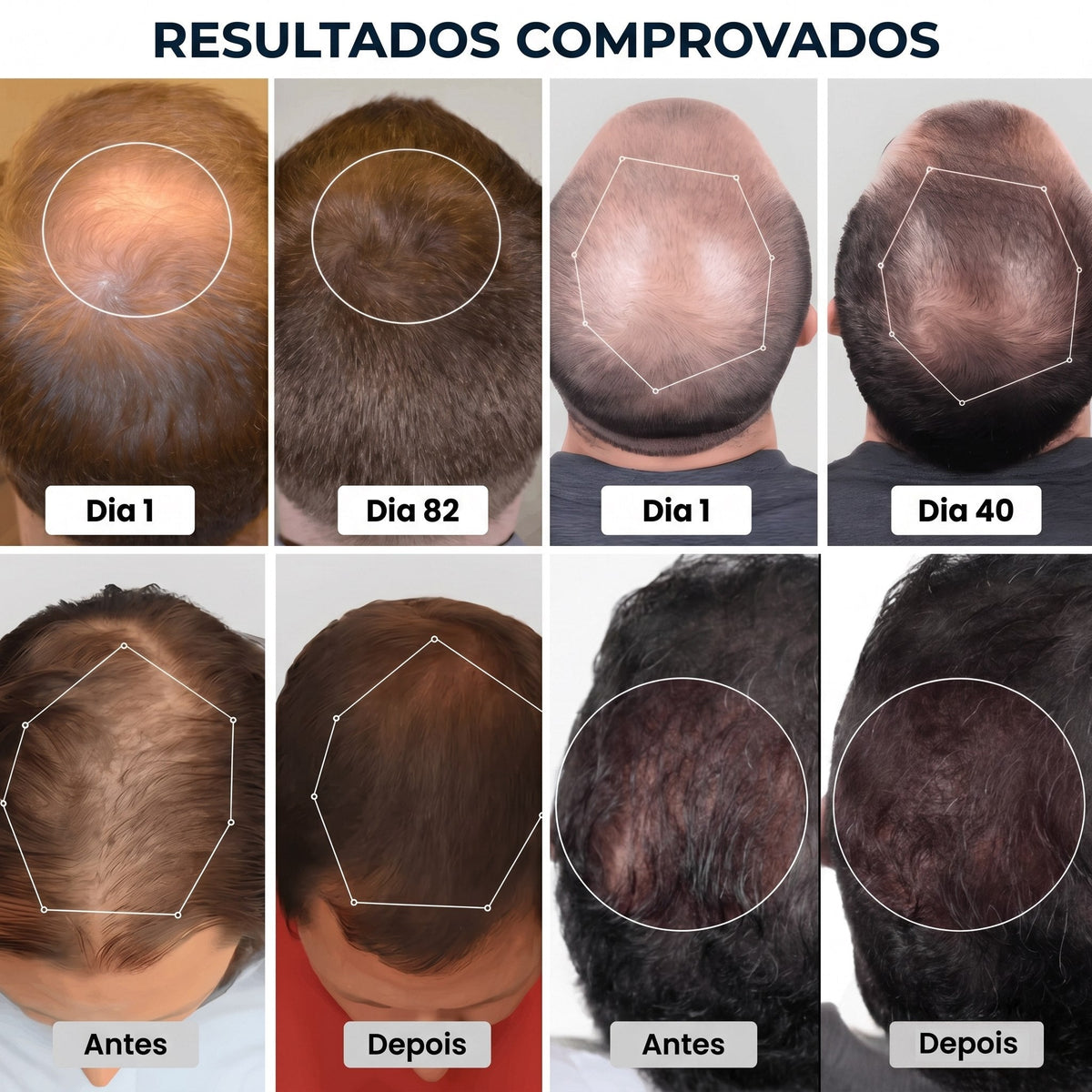 Tecnologia LED para Crescimento Capilar - HairLux™ Pro